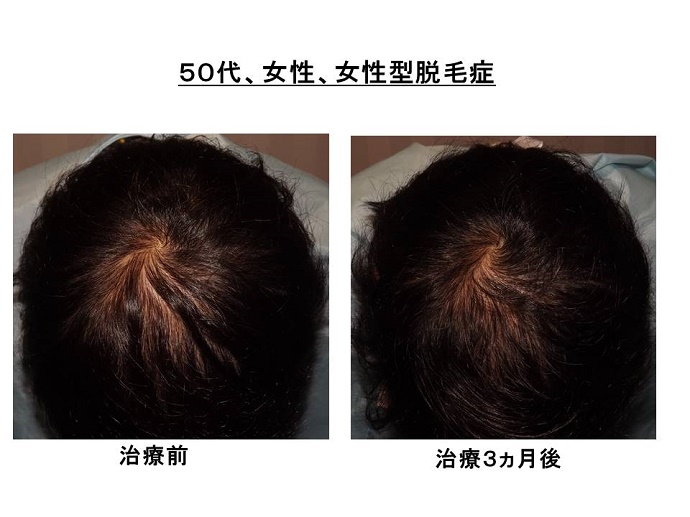 円形脱毛症　病院""